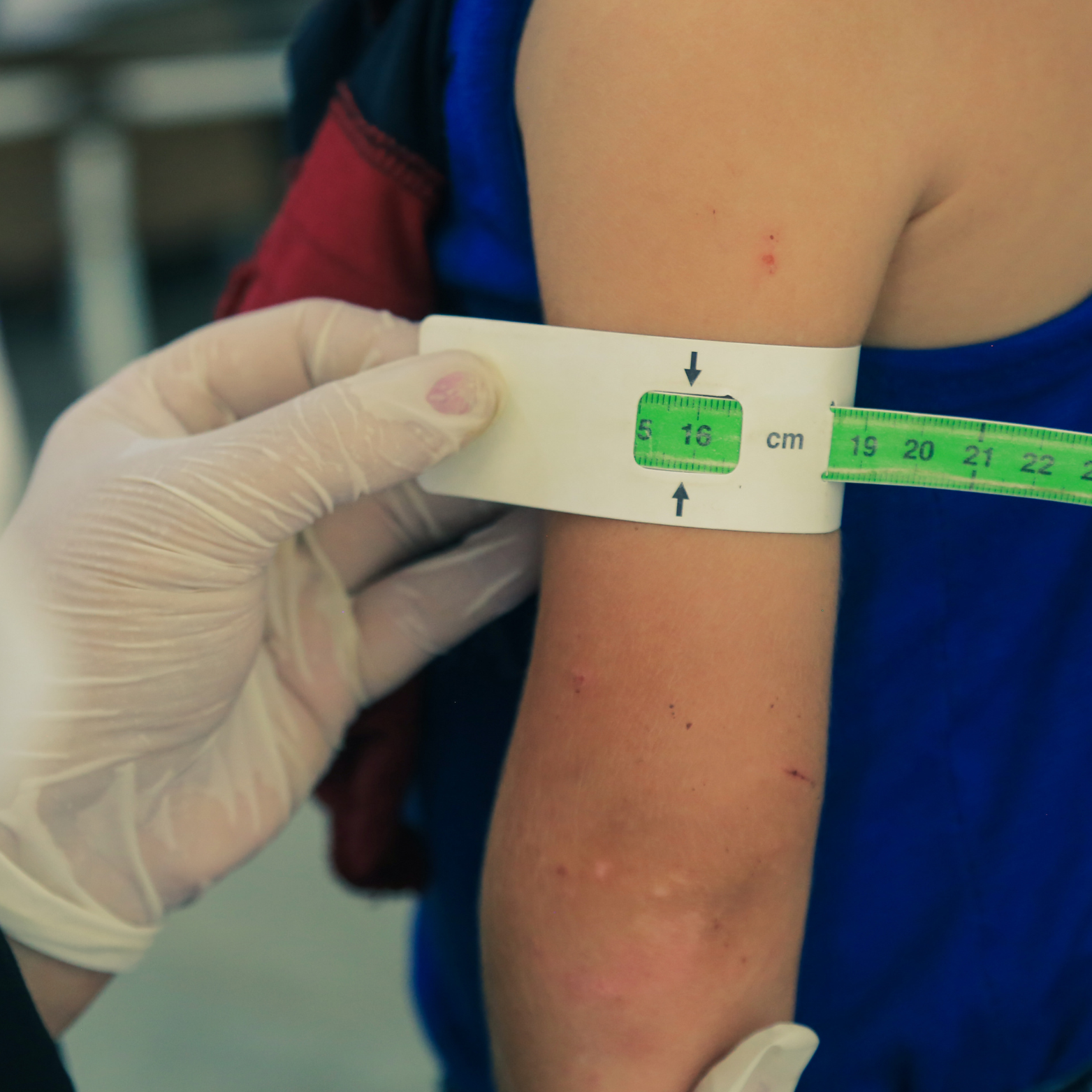 Recognising signs of malnutrition